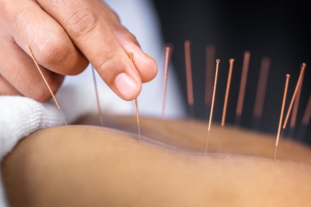 Dry Needling Course Image
